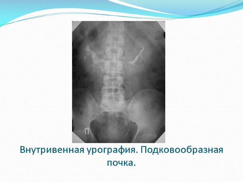 Внутривенная урография. Подковообразная почка.